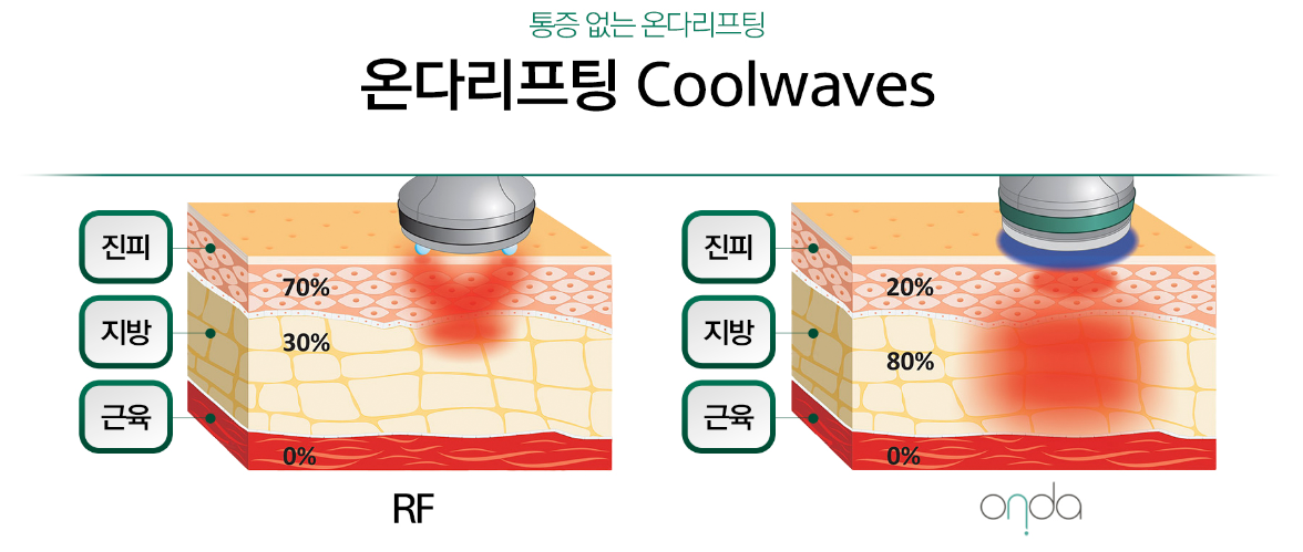 온다리프팅 원리 잠실피부과 닥터에버스