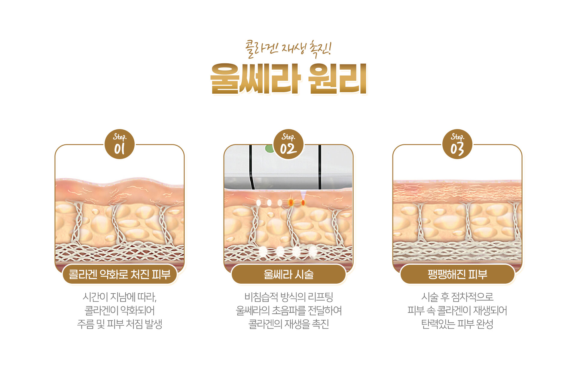 울쎄라 원리 잠실피부과 닥터에버스 울쎄라 원리 잠실피부과 닥터에버스