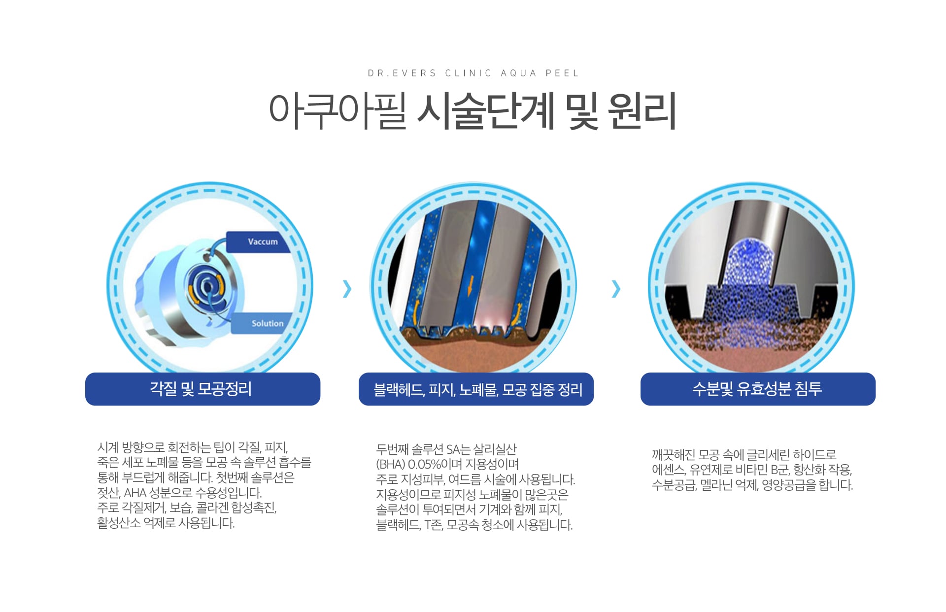 아쿠아필 효과 잠실피부과 닥터에버스 아쿠아필 효과 잠실피부과 닥터에버스