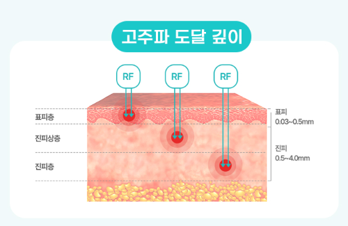 포텐자 유지기간 잠실피부과 닥터에버스 포텐자 유지기간 잠실피부과 닥터에버스
